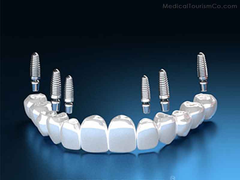 3 0n 6 dental implants