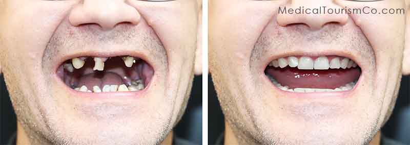 Dental Implants Vs. Dentures: Rehabilitation