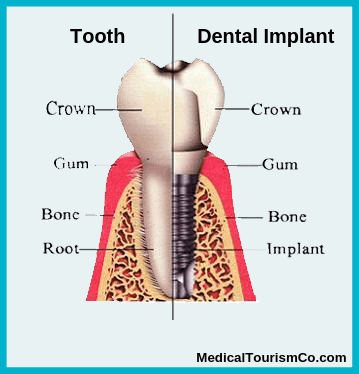 Dental Implant and natural tooth