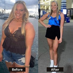 Before & After Results of Bariatric Surgery in Mexico