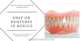 Clip on Dentures in Mexico