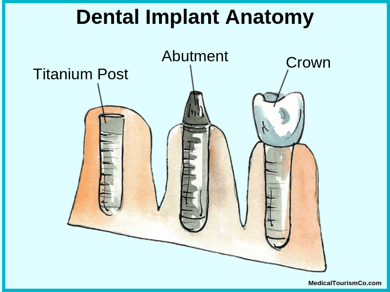 Dental Implant Anatomy | Dental implants in Colombia