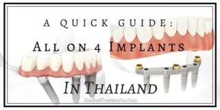 all on 4 dental packages in thailand