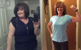 Before and After Weight Loss Surgery in Mexico
