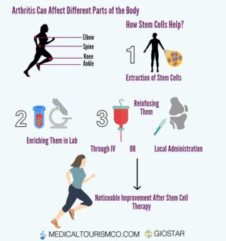 Arthritis Stem Cell Therapy in Mexico - Infographic