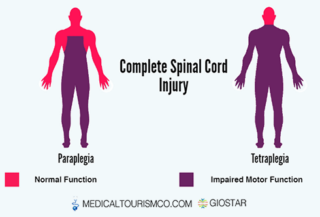 Complete-Spinal-Cord-Injury