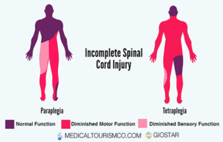 Incomplete-Spinal-Cord-Injury
