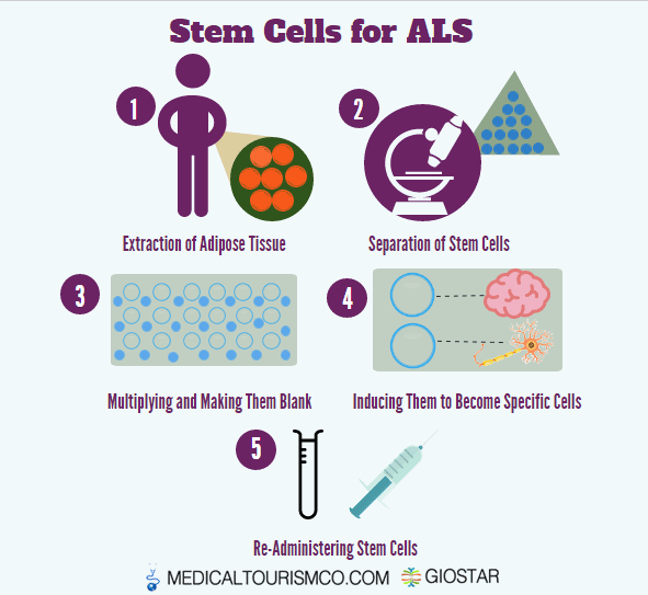 Stem-Cell-ALS-Therapy-in-Mexico