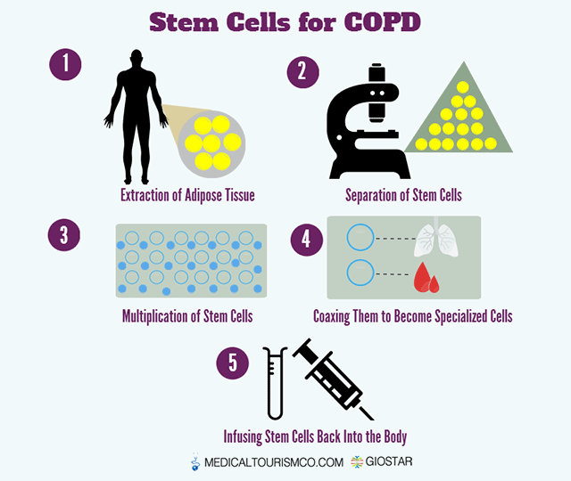 Stem-Cell-Treatment-for-COPD-in-Mexico