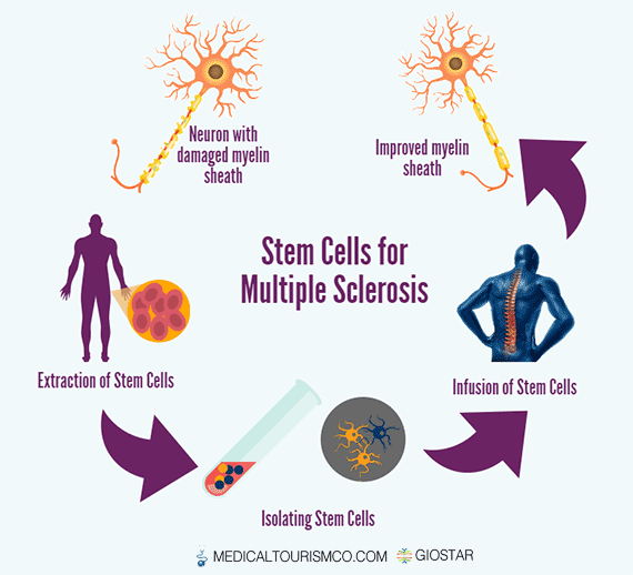 Stem-Cells-for-Multiple-Sclerosis-in-Mexico