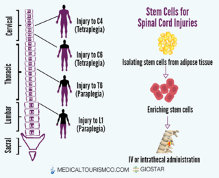 Stem-cells-for-Spinal-cord-Injury-in-mexico