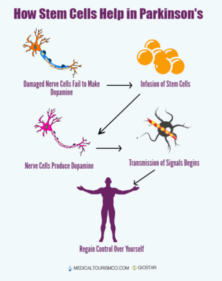 Stem Cells Treatment - Parkinson's - Infographic