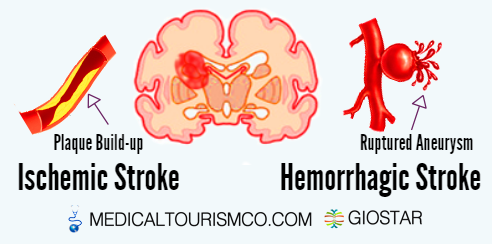 Types-of-Stroke-Treated-With-Stem-Cells-in-Mexico