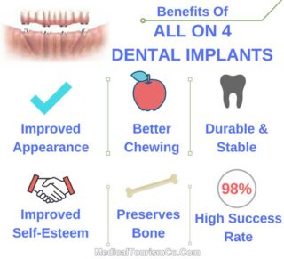 Benefits Of All-on-4 Dental Implants
