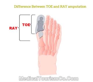 Difference Between Toe and Ray Amputation