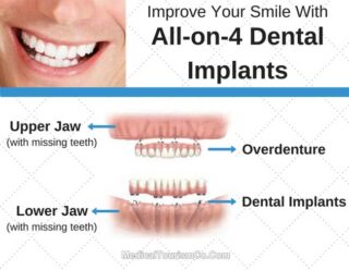 Improve Your Smile With All-on-4 Dental Implants