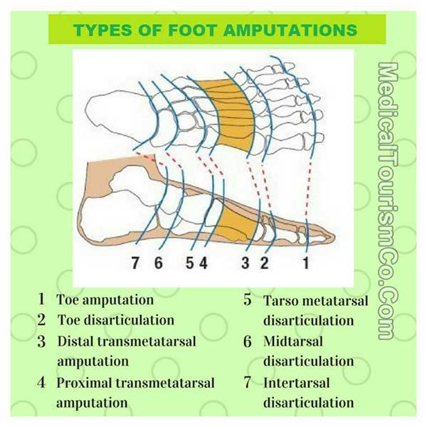 Types Of Toe And Foot Amputations