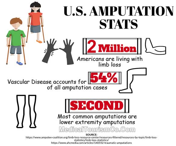 US Amputation Stats