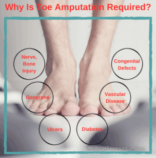 Why Is Toe Amputation Required