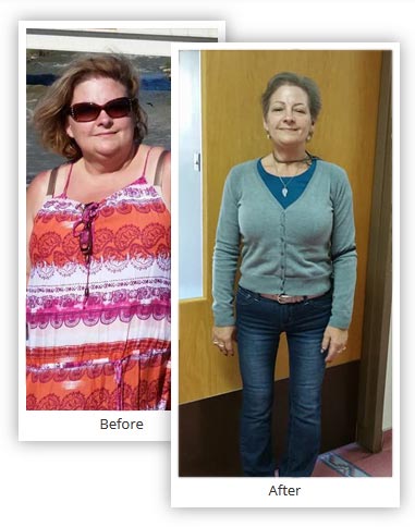 Bariatric Surgery Mexico Before After