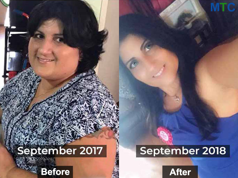 Before & After of Weight Loss Surgery in Mexico