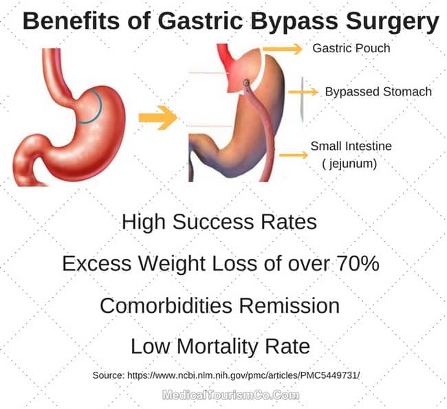 Gastric Bypass Explained