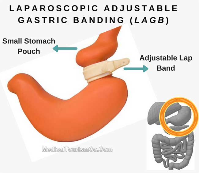 Gastric Banding Explained