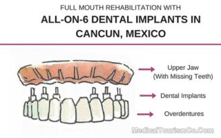 All-on-6 Dental Implants in Cancun Mexico