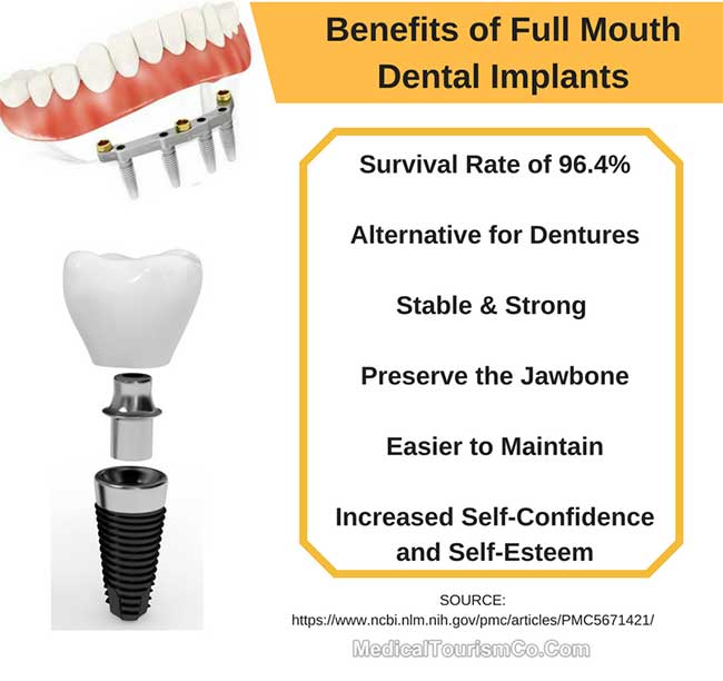 Benefits of Full Mouth Dental Implants