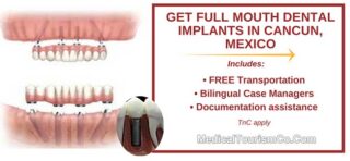 Upper and Lower Mouth Implants in Cancun Mexico
