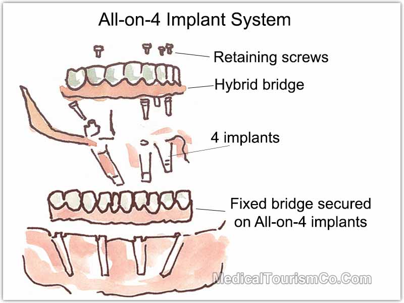 All-on-4 Dental Implants in Cabo, Mexico