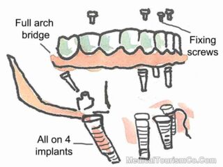 All-on-4 Dental Implants in Cancun - Mexico