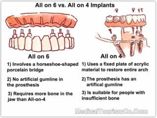 All-on-6 Implants vs All-on-4