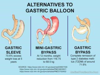 Alternatives to Gastric Balloon