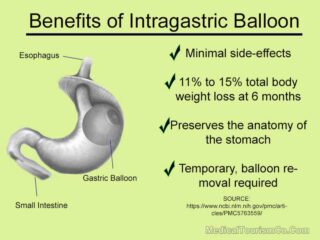 Benefits of Gastric Balloon