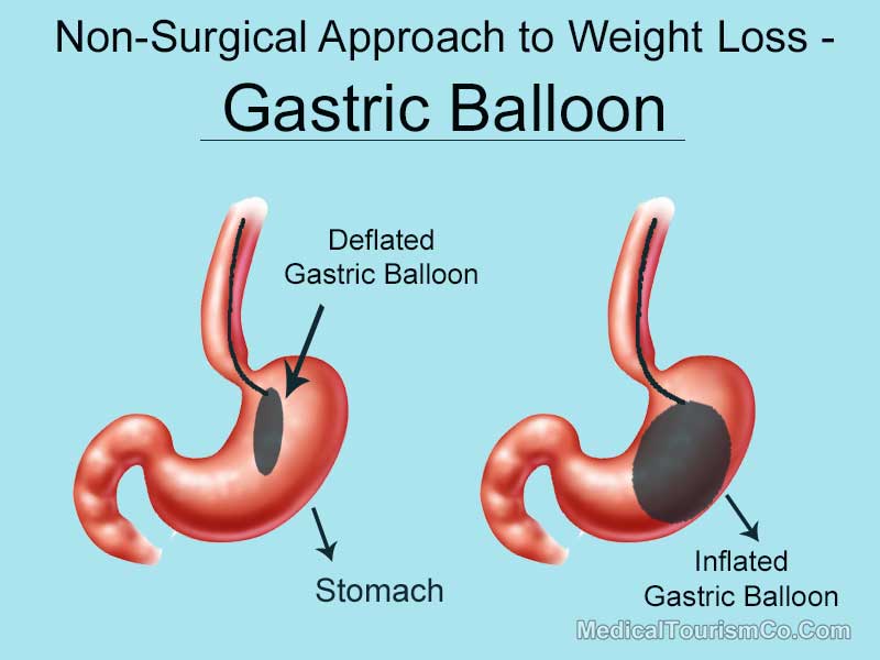 Gastric balloon