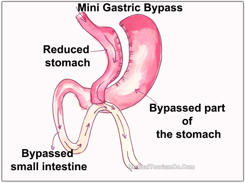 Mini Gastric Bypass Vs Gastric Bypass- Mini Gastric bypass