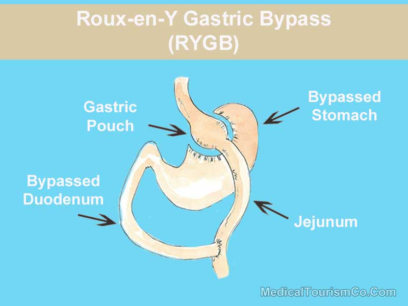Roux-en-Y Gastric-Bypass Explained