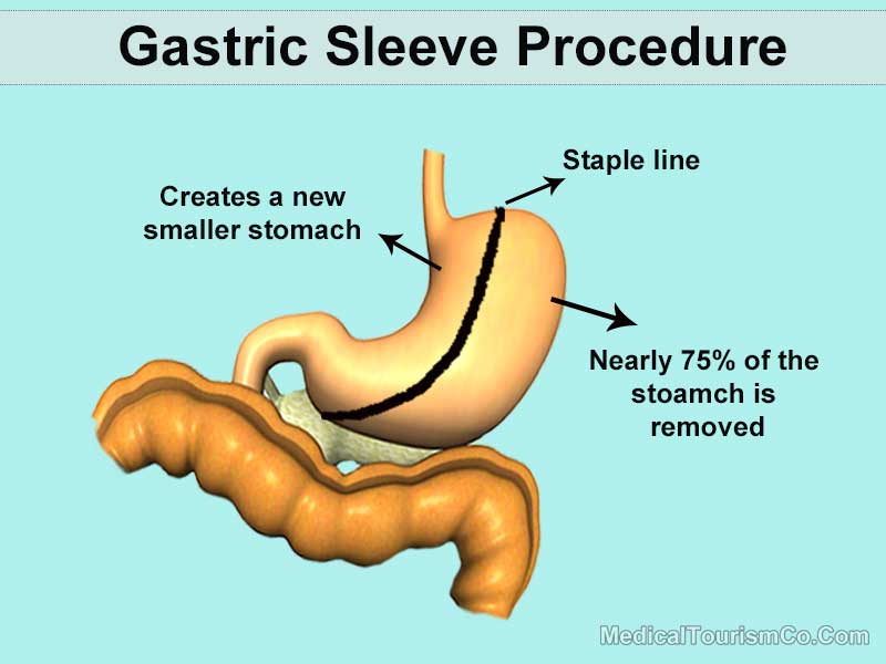 Gastric Sleeve Explained