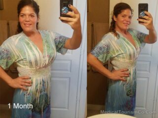 1 Month After Gastric Bypass Mexico