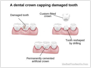 Dental-Crowns-in-Cancun---Mexico