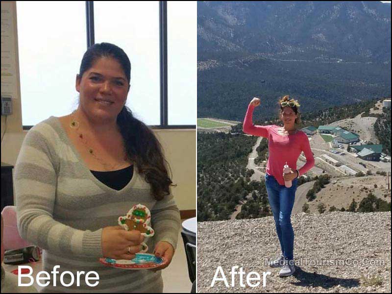 Gastric Bypass Before After Pic - Mexico