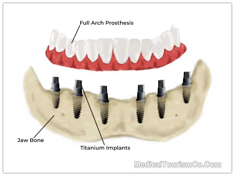 All on 6 Dental Implant