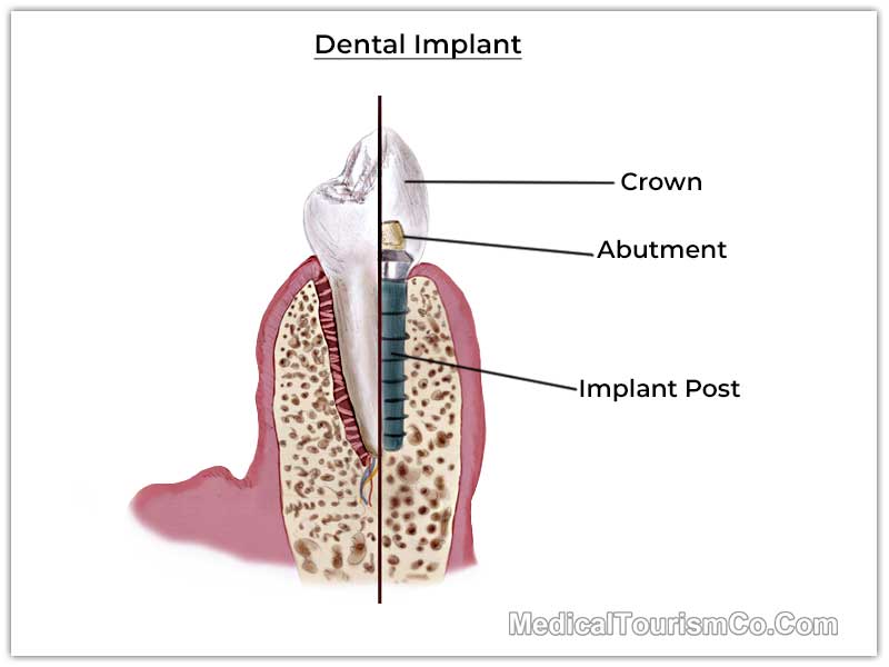 Single dental implant in Ahmedabad