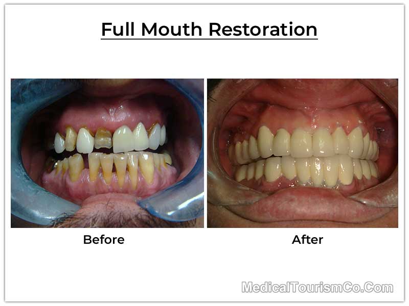 Full Mouth Restoration Before and After