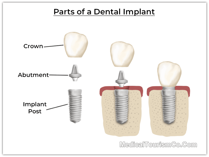 Parts of Dental Implants
