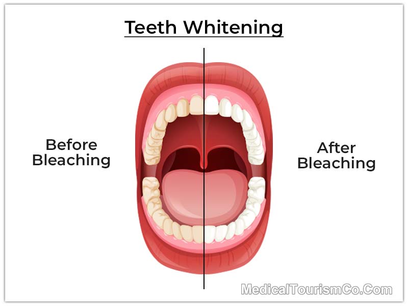 Teeth Whitening Cabo, Mexico Before After