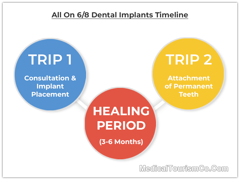 Dental Implants Process Steps
