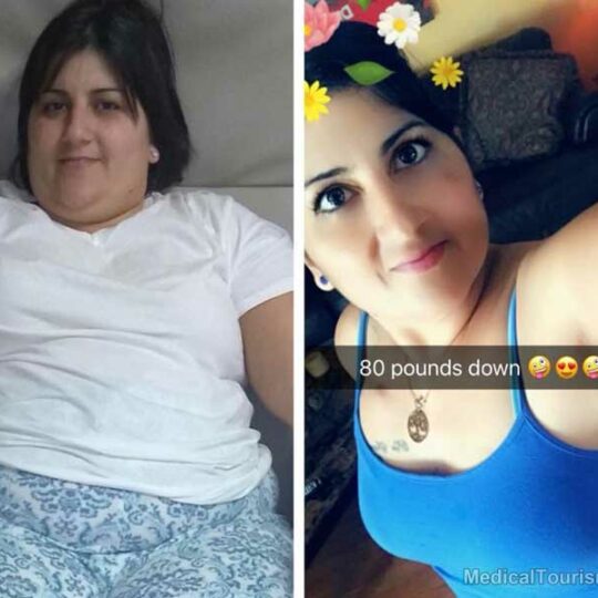 6 Months Gastric Sleeve Tijuana before after