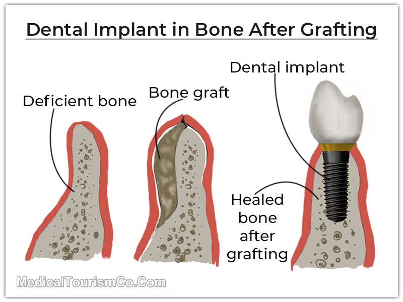 Dental Implants after Bone Grafting 